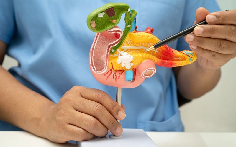 Pancreatic cancer