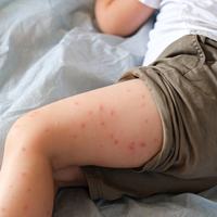 Measles