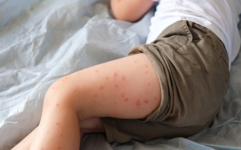 Measles